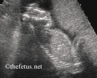 anencephaly, sagital section 2nd trimester